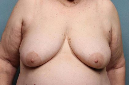 Breast Reconstruction Before & After Patient #8804