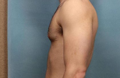 Gynecomastia Before & After Patient #9121