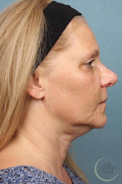 Kybella Before & After Patient #9093