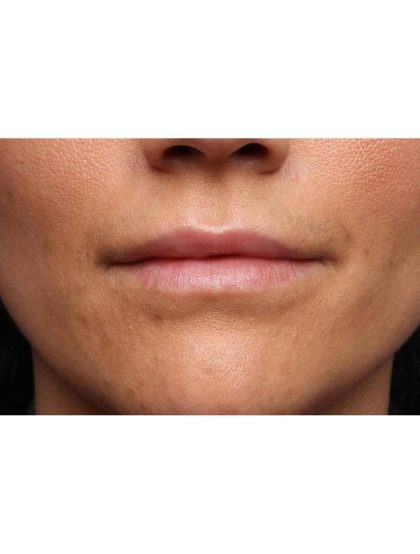 Juvederm Before & After Patient #9113