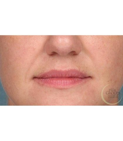 Lip Augmentation Before & After Patient #9029
