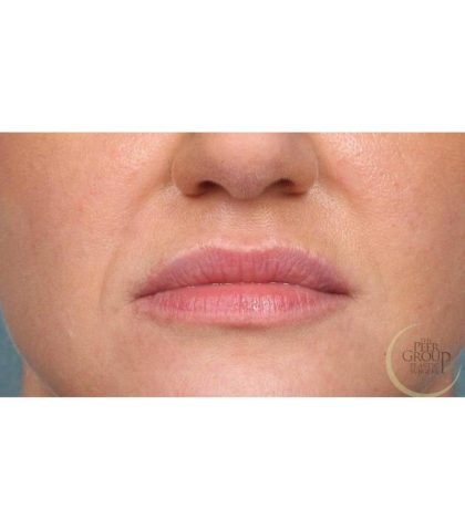 Lip Augmentation Before & After Patient #9029