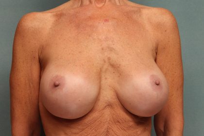 Breast Augmentation Before & After Patient #9542
