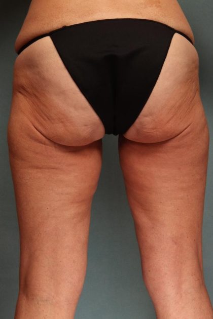 Liposuction Before & After Patient #9546