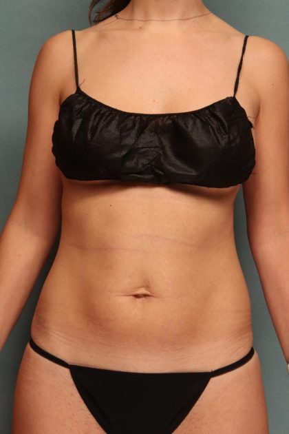 Tummy Tuck Before & After Patient #9547