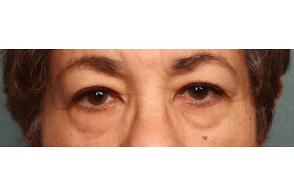 Blepharoplasty Before & After Patient #9548