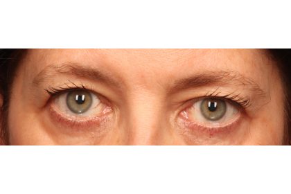 Blepharoplasty Before & After Patient #9819