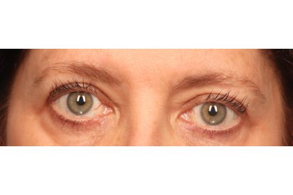 Blepharoplasty Before & After Patient #9819