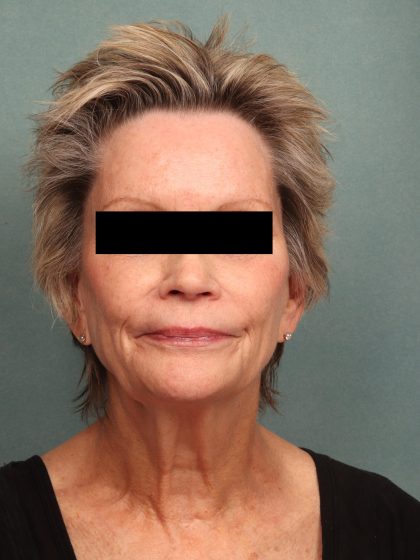 Facelift Before & After Patient #9966