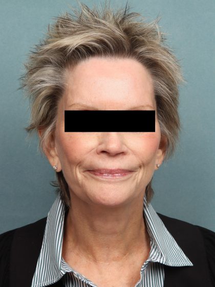 Facelift Before & After Patient #9966