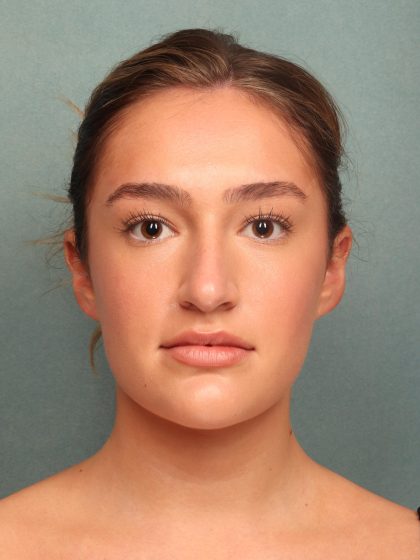 Rhinoplasty Before & After Patient #10045