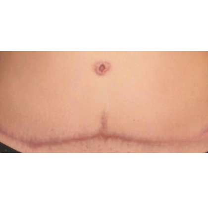 Scar & Stretch Mark Treatment Before & After Patient #10098