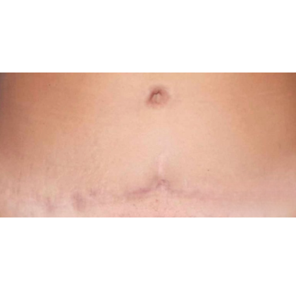 Scar & Stretch Mark Treatment Before & After Patient #10098