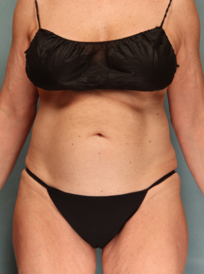 Tummy Tuck Before & After Patient #10122