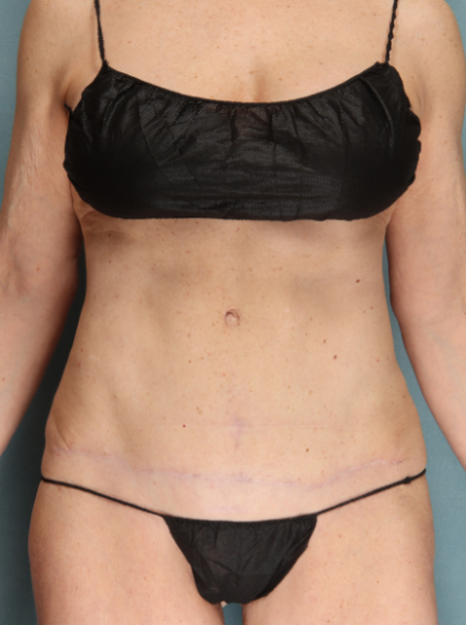 Tummy Tuck Before & After Patient #10122